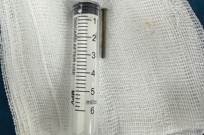 gắp dị vật đinh sắt dài 3cm